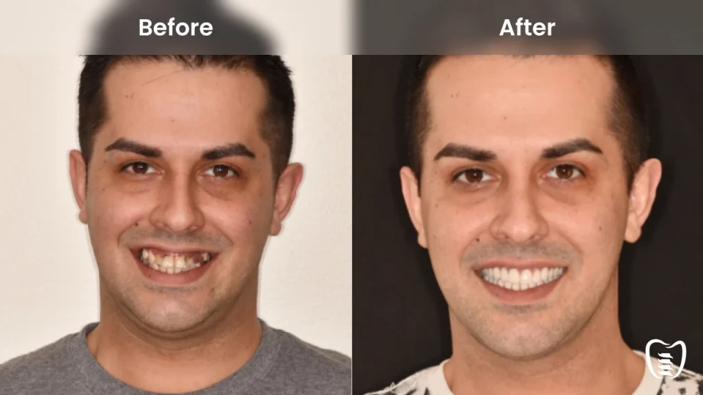 Before and after dental implants at All On Implants Columbus