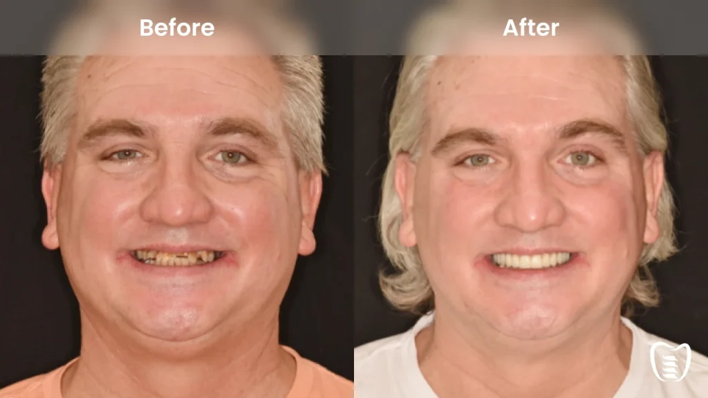 Before and after dental implants at All On Implants Columbus