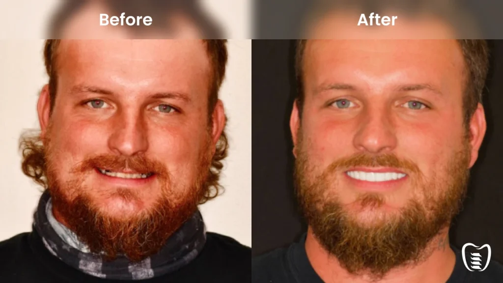 Before and after dental implants at All On Implants Columbus