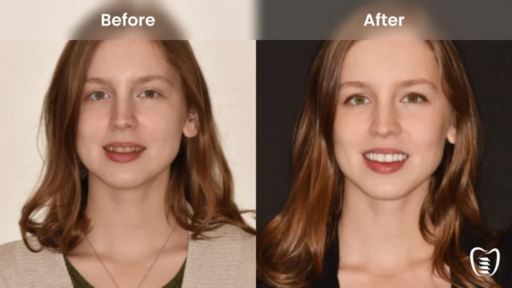 Before and after dental implants at All On Implants Columbus