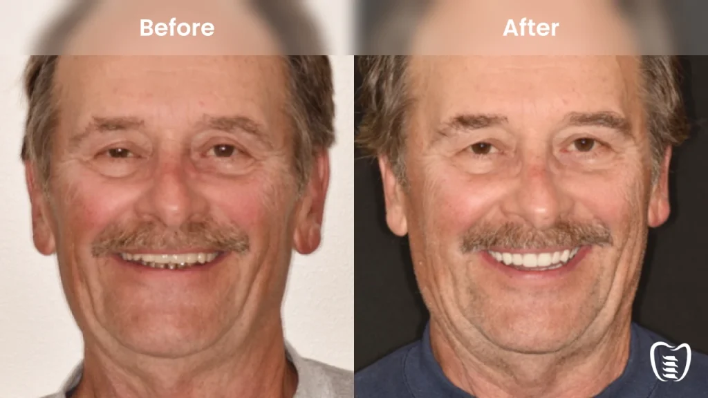Before and after dental implants at All On Implants Columbus