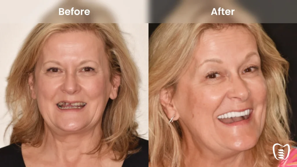 Before and after dental implants at All On Implants Columbus